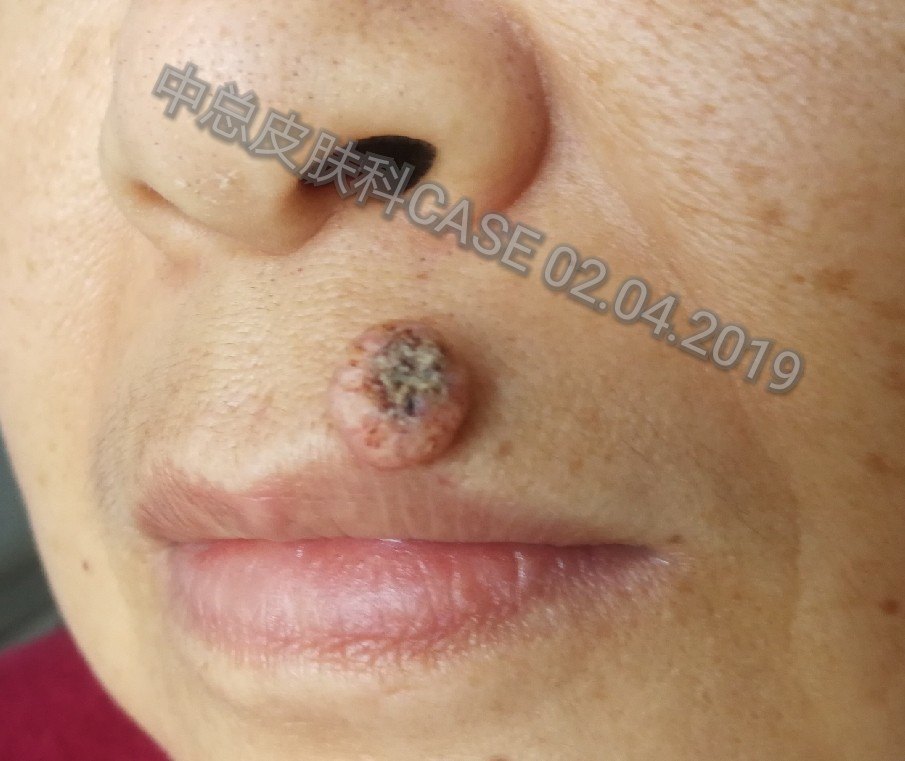上唇肿物3月,迅速增大,拟诊角化棘皮瘤病理基础上的原位切除,无辅助