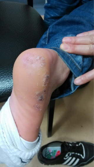 综合性治疗快速治愈多发性跖疣一例 - 好大夫在线