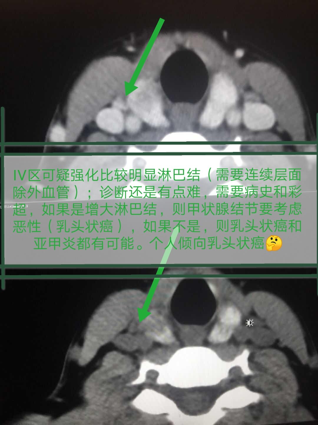 甲状腺癌ct表现图片