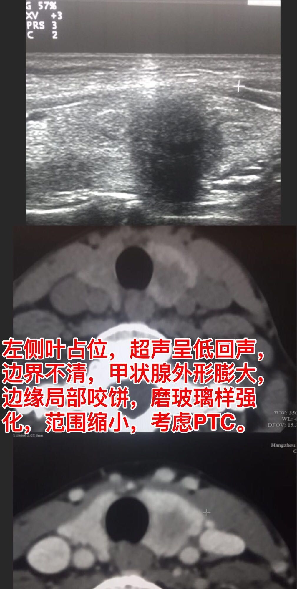 ct彩超诊断甲状腺乳头状癌易误诊亚甲炎1例