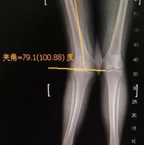 股骨远端闭合截骨(dfo)治疗严重膝外翻畸形 - 好大夫在线