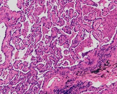 磨玻璃结节早期肺腺癌病理诊断中的问题与探讨 - 好大夫在线