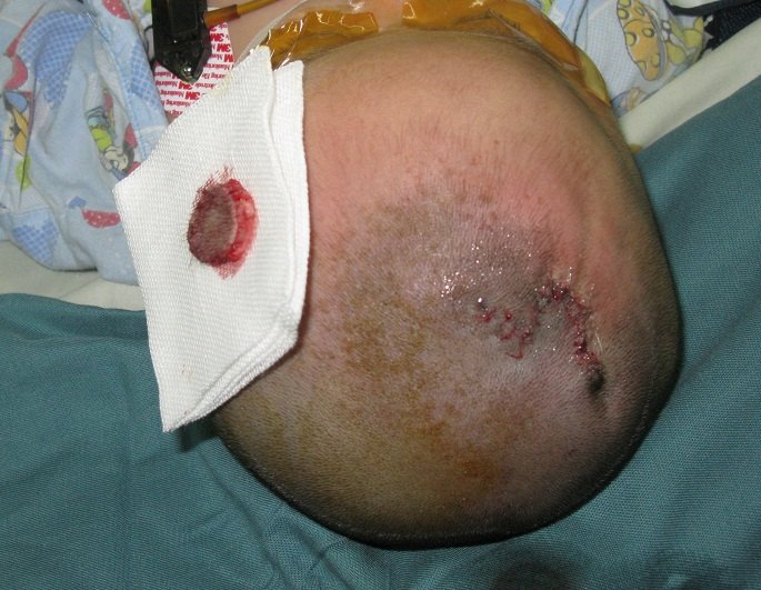 什么样的血管瘤建议来整形外科动手术?(一) - 好大夫在线