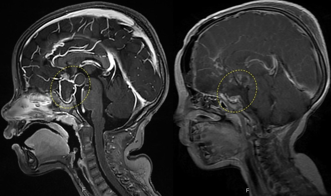颅咽管瘤的一站式治疗 - 好大夫在线