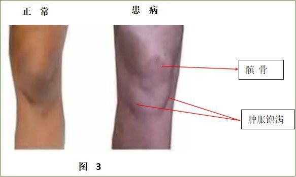膝关节脂肪垫位置图图片