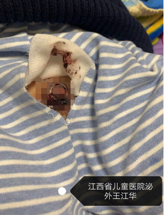 包皮术后常见问题图解_包皮过长_手术_康复_治疗方式_康复锻炼 - 好