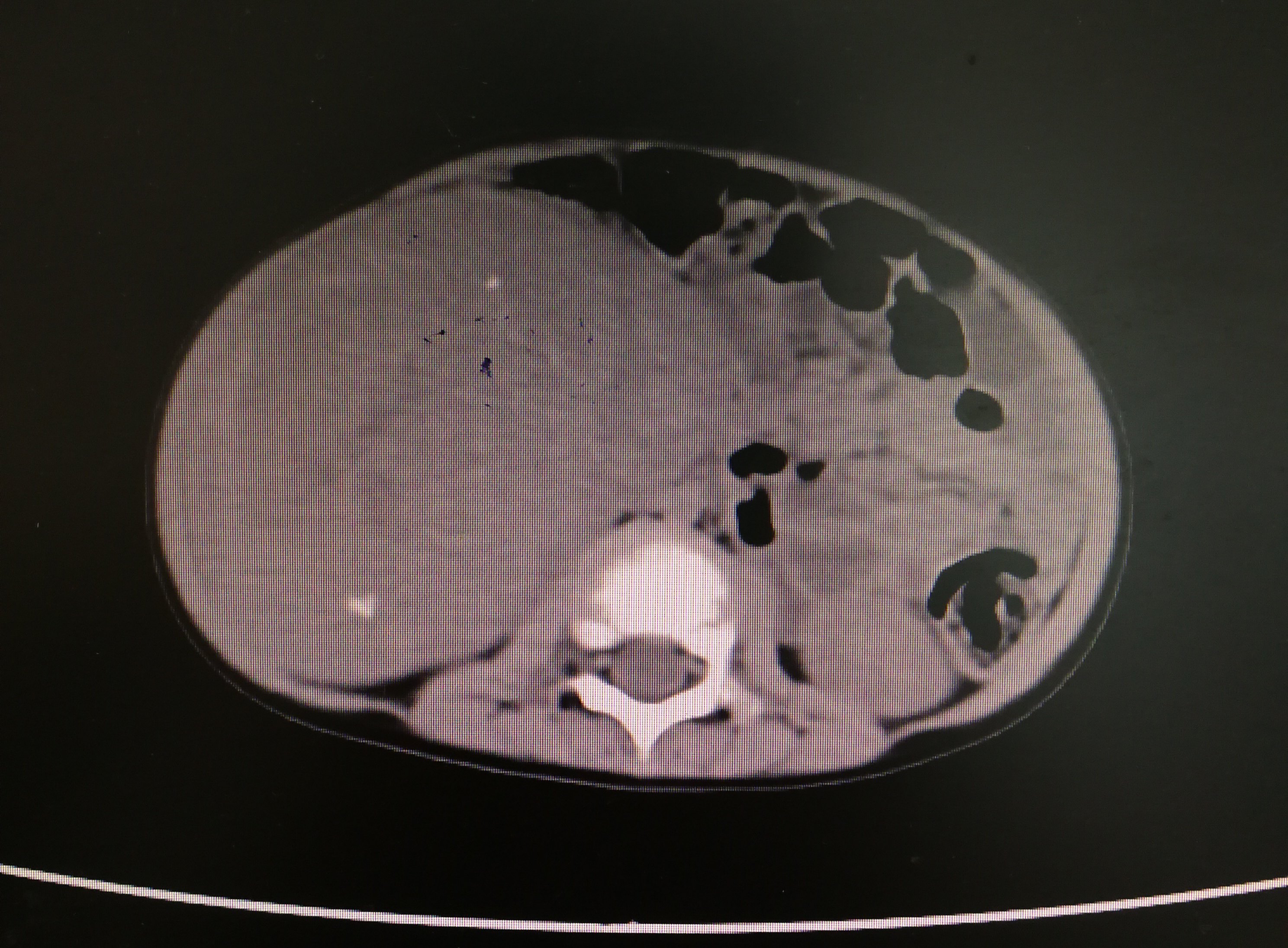 肾母细胞瘤小儿腹部的定时炸弹