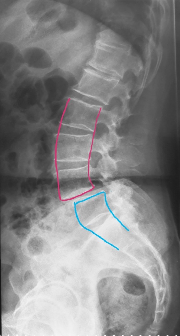 腰椎滑脱图片x线诊断图片