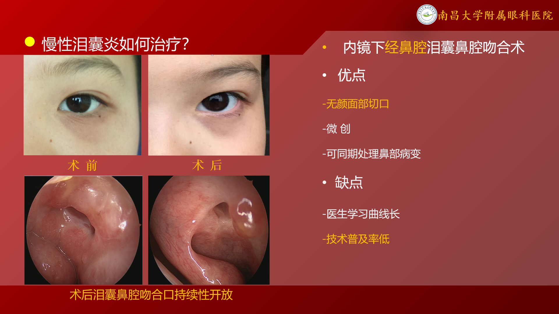 “泪囊炎”如何治疗? - 好大夫在线
