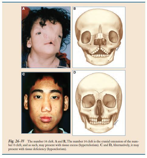 【小儿整形】图鉴——形形色色的面裂 - 好大夫在线