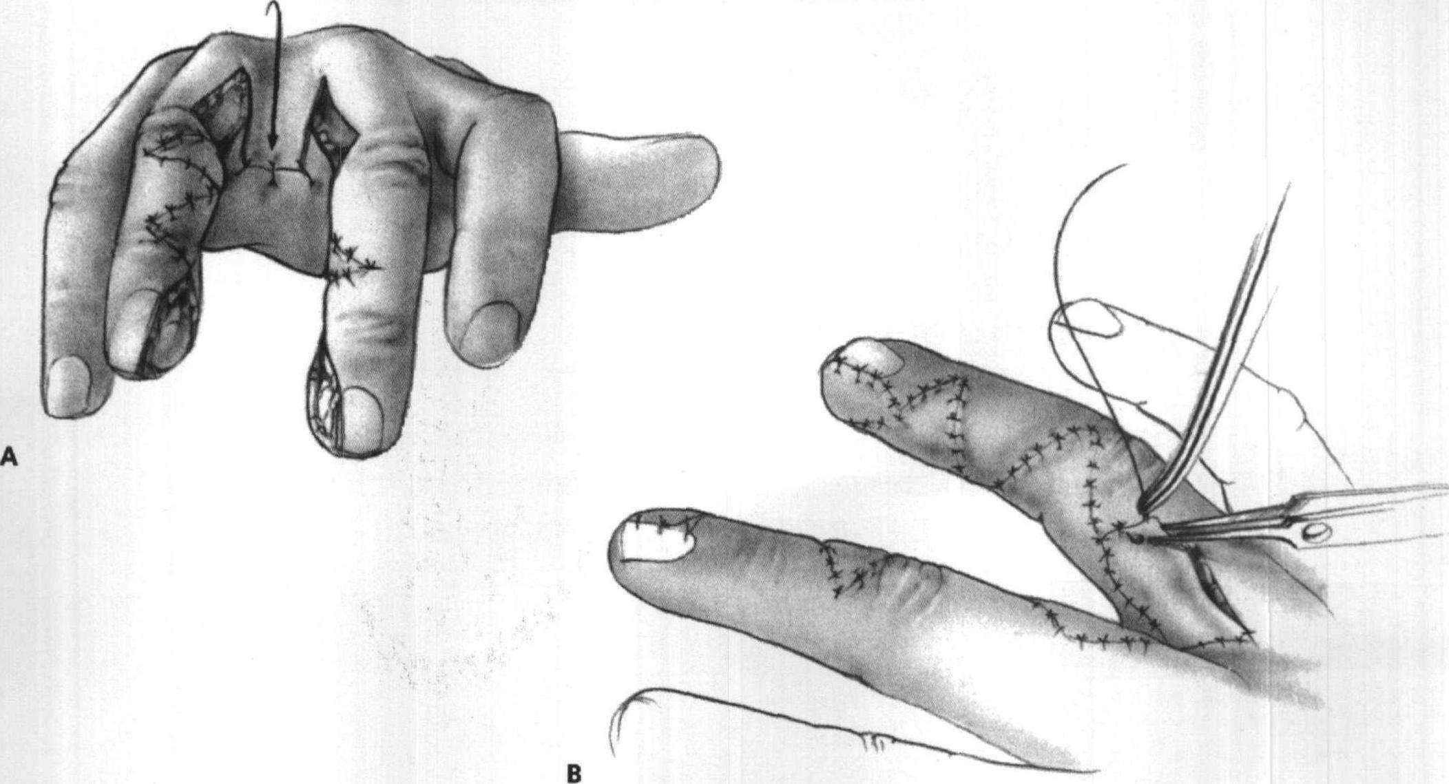 并指畸形_并指畸形治疗方法 - 好大夫在线