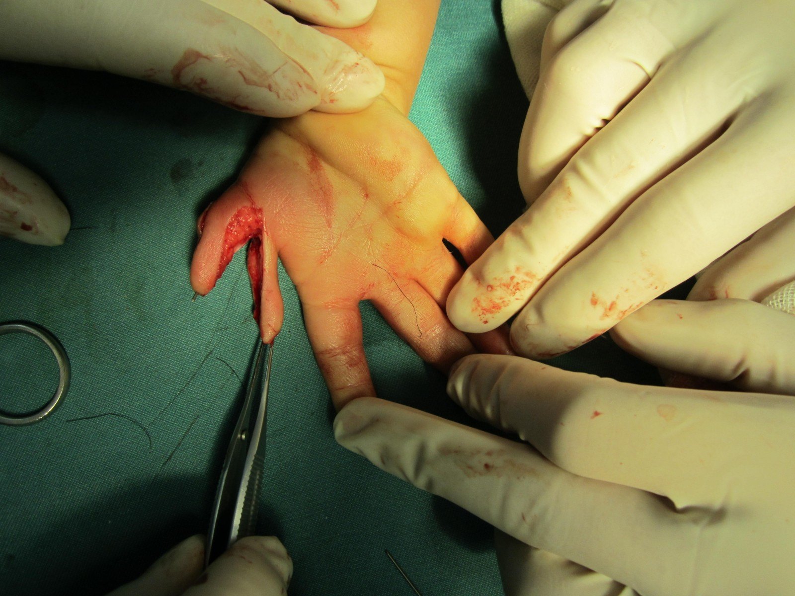 包含擅长:在先天性或后天性畸形的临床整复、组织移植、器官再造、美容外科等领域有较深的造诣。跑腿预约挂号,办事效率高的词条