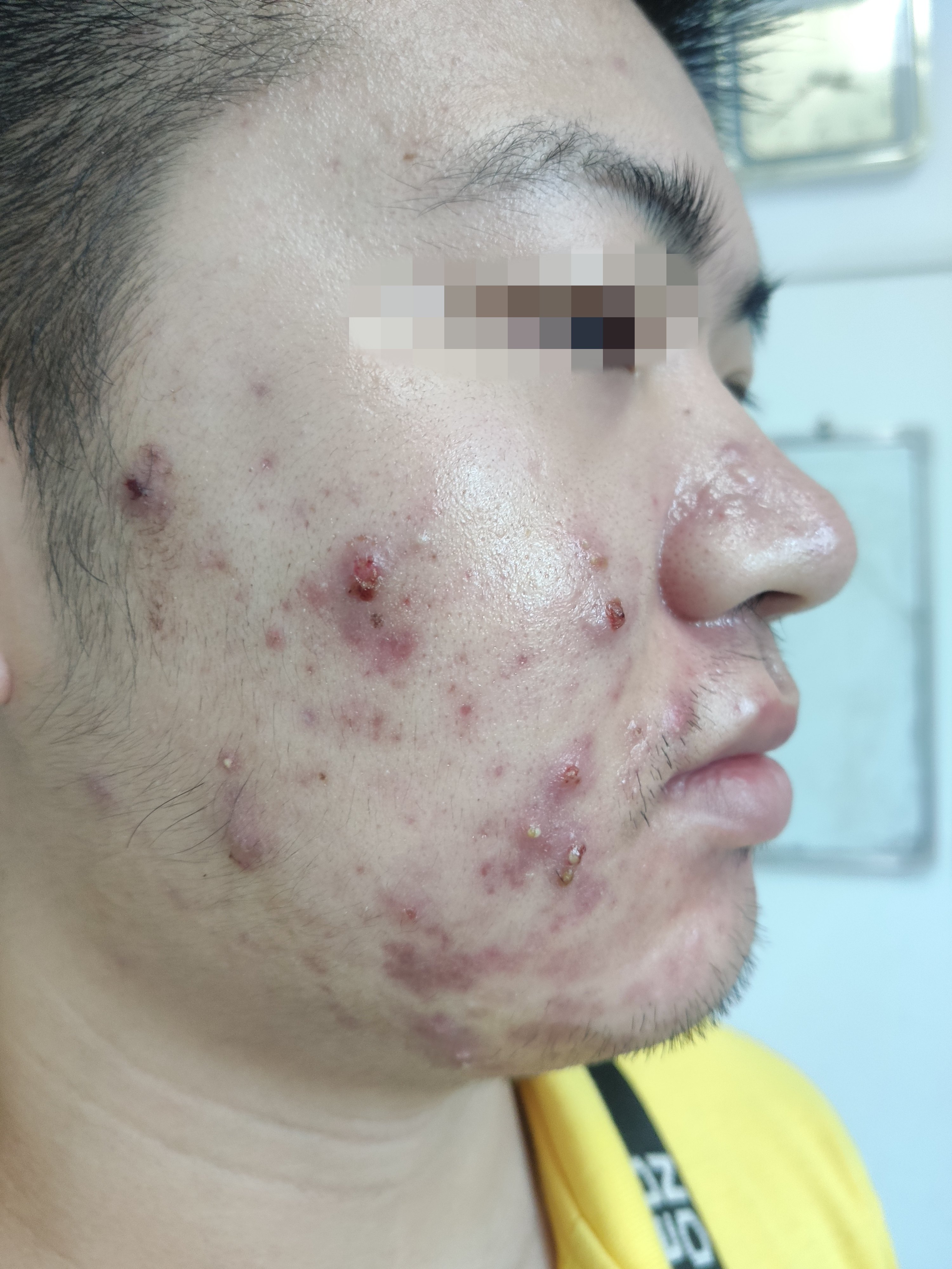 顽固的痘痘 - 好大夫在线