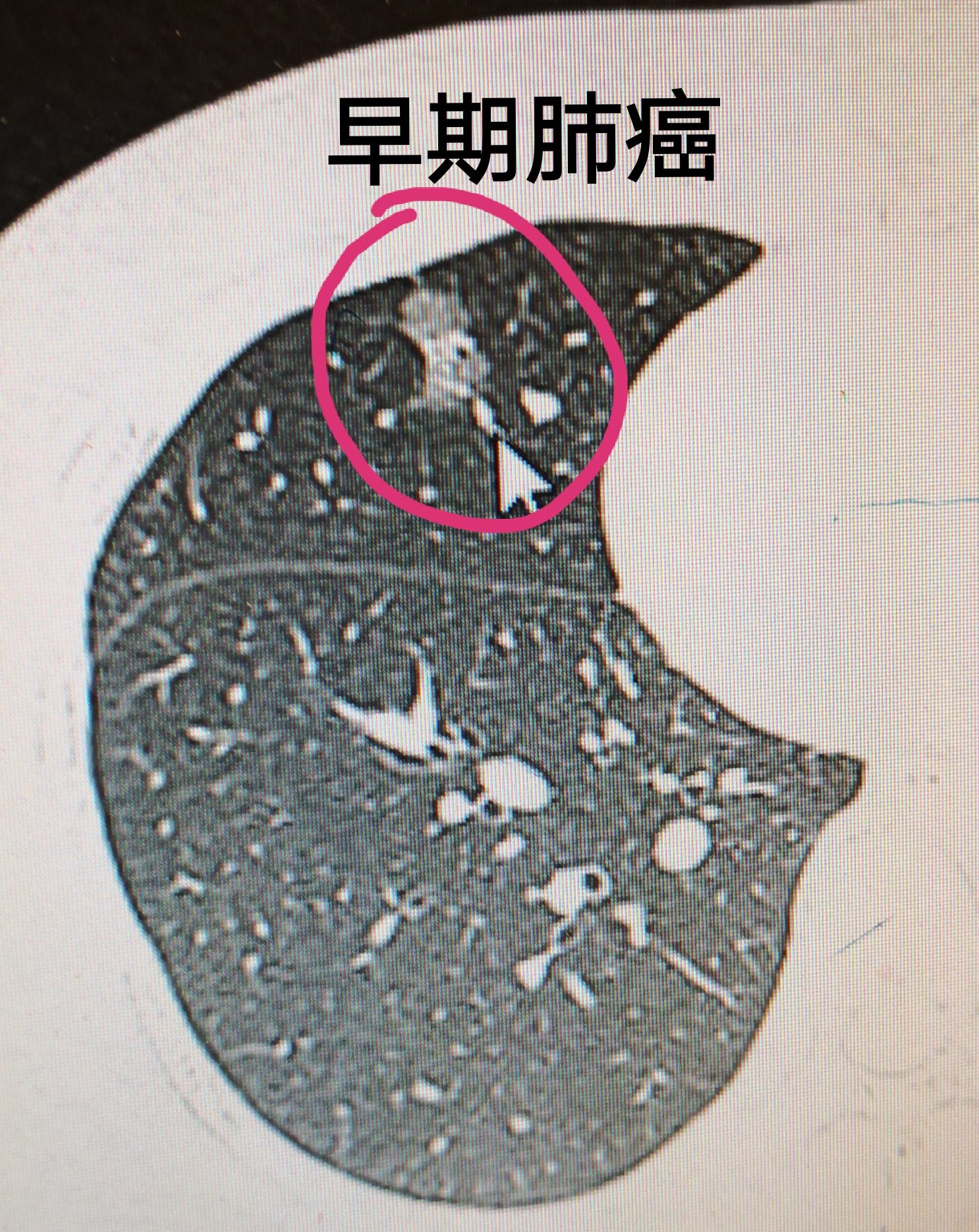 肺部有结节0.8cm癌指数高_肺上结节80%是肺癌_肺部结节80%是肺癌