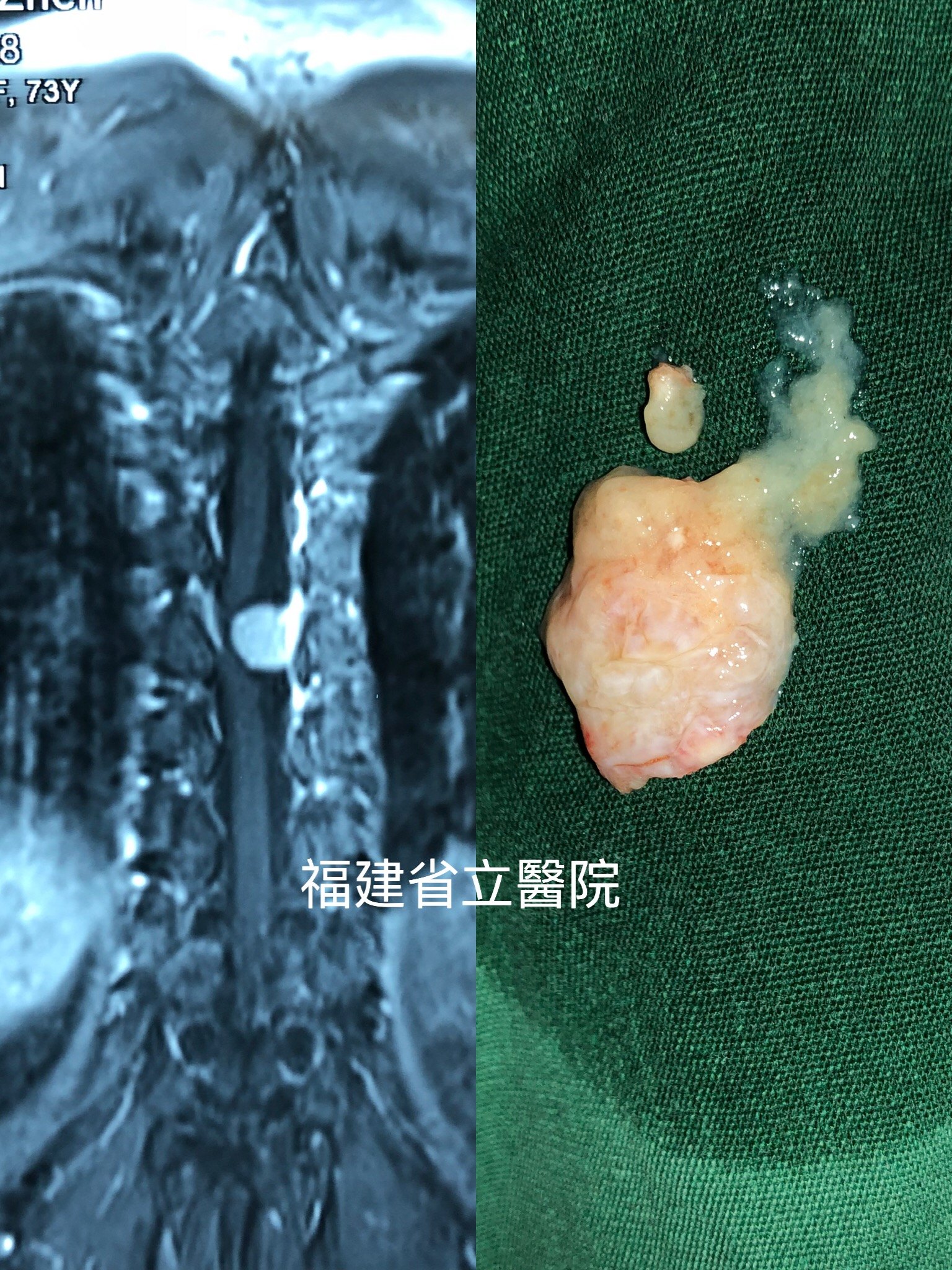 脊膜瘤晚期图片