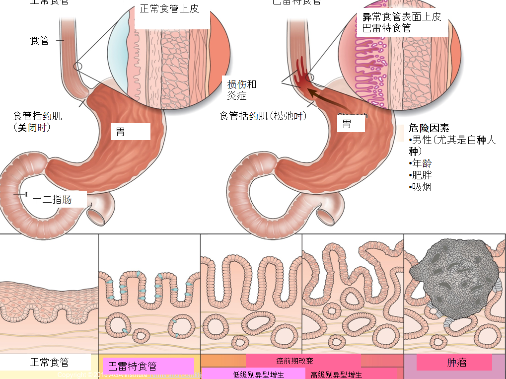 巴雷特食管全周型图片