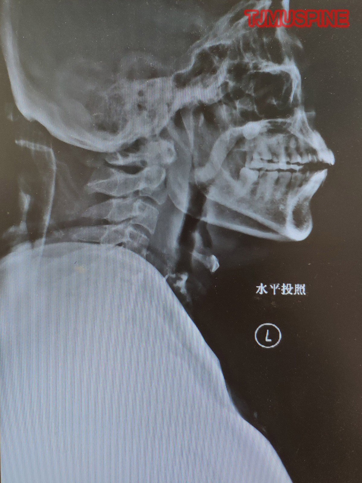 頸椎椎管狹窄