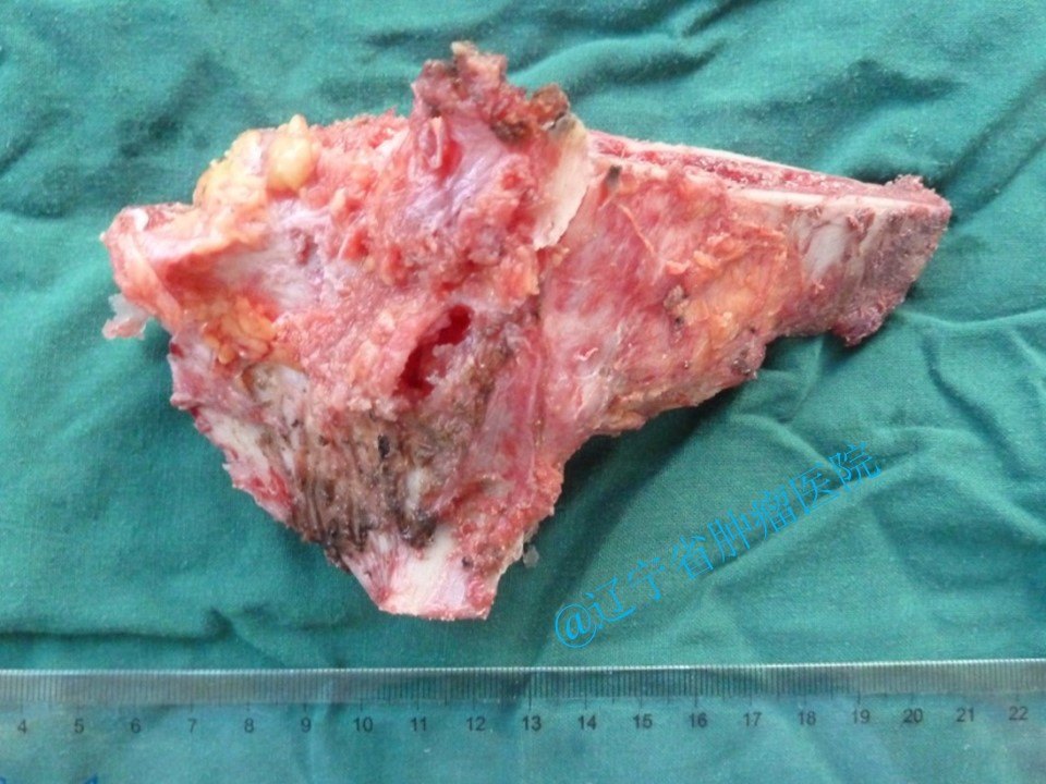 髋臼恶性肿瘤骨盆假体置换术 - 好大夫在线