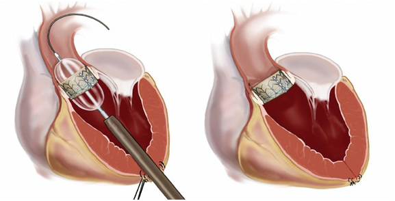 杨秀滨教授微创介入瓣膜(tavi/tavr)绿色通道(一)_主动脉瓣狭窄_手术