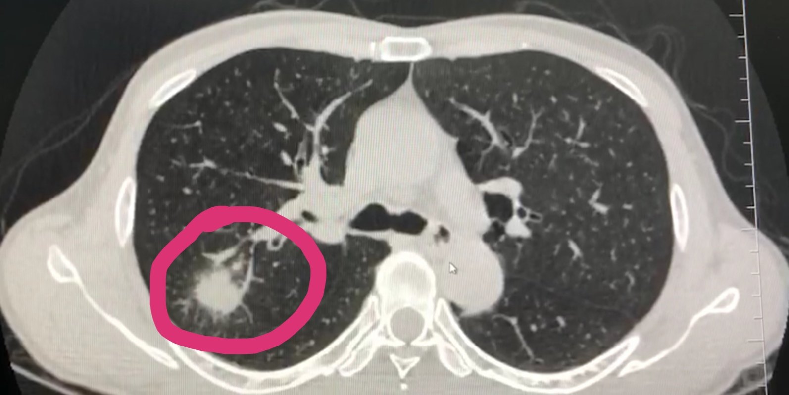 右肺下叶背段结节图片