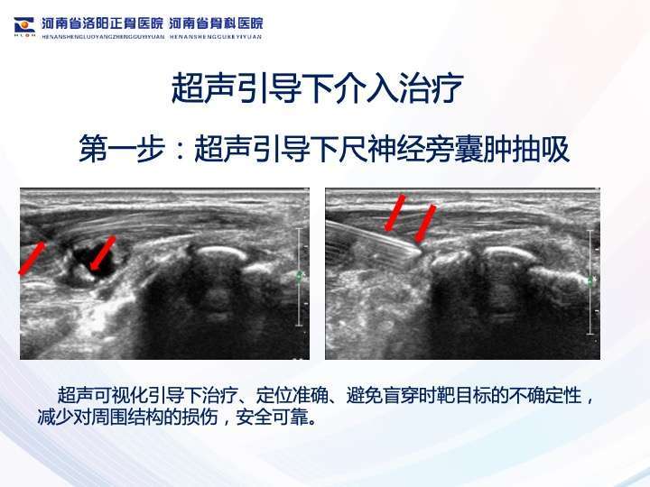 肘管综合征介入微创治疗 - 好大夫在线