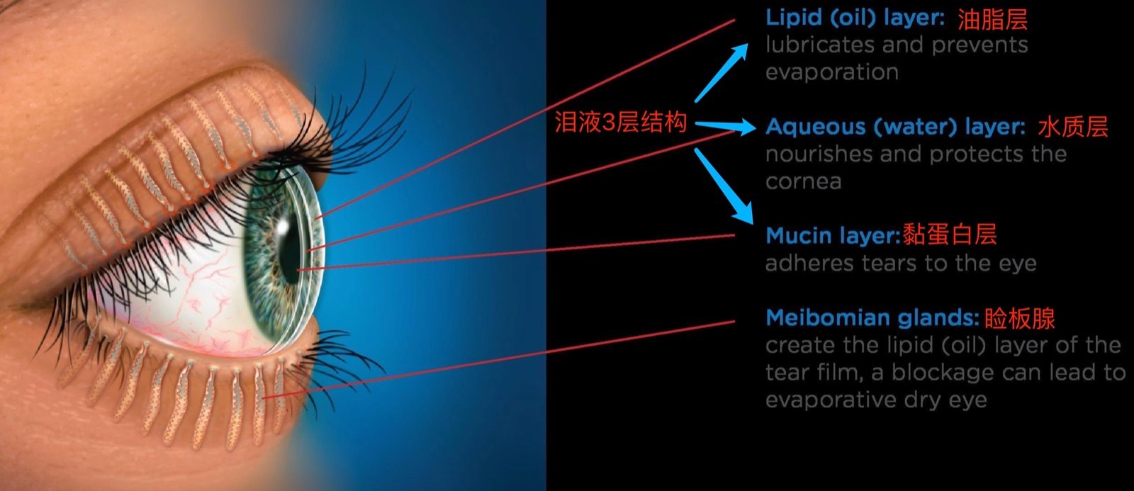 近视手术术前清洁睑缘很重要! - 好大夫在线