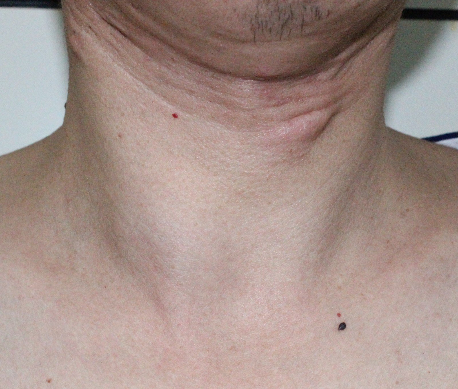 甲状腺结节图片 男性图片
