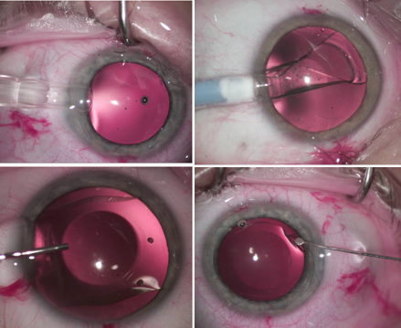 Icl临床专家共识 附视频 Icl临床专家共识 附视频