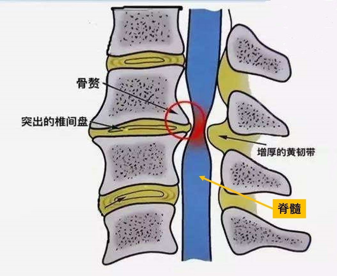 高压脊示意图图片