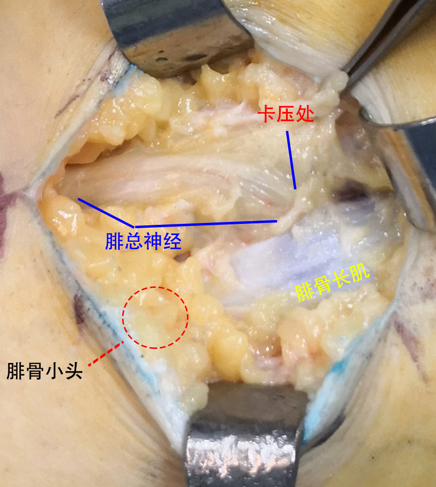 脚背麻脚下垂不能勾脚是怎么回事儿下肢神经松绑解救记
