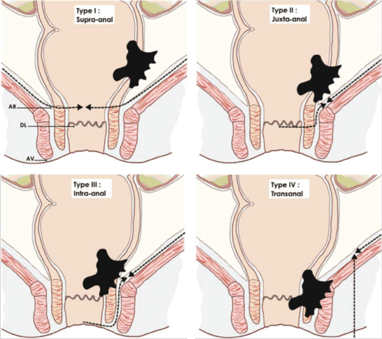 低位直肠癌能保肛吗?_直肠癌_症状表现_治疗方式 - 好大夫在线