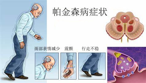 帕金森_帕金森症状表现 - 好大夫在线