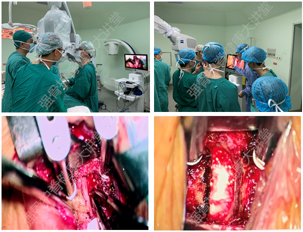 高度约5-9毫米,体积很小,局部神经卡压部位更是细小,传统肉眼下手术