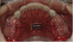图3上颌垫舌簧矫治器当小朋友存在乳牙或恒牙早失问题时