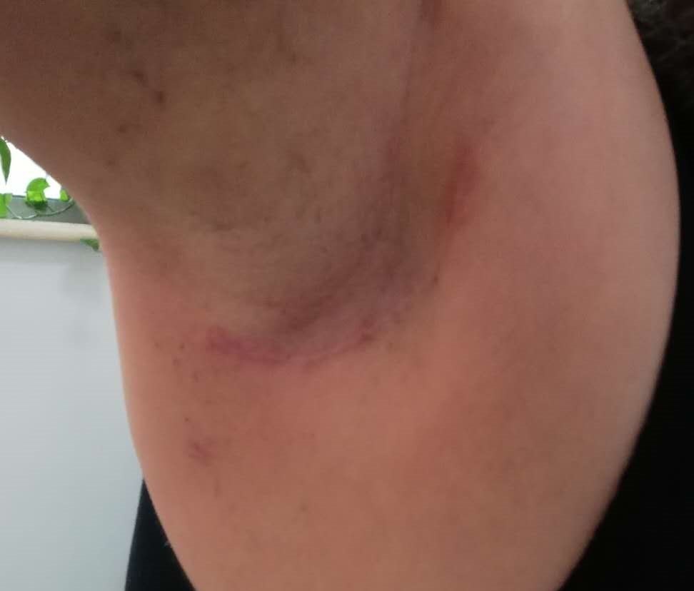 副乳术后对身体有什么影响(副乳术后对身体有什么影响吗) 副乳术后对身体有什么影响(副乳术后对身体有什么影响吗)