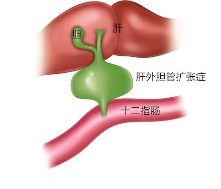 胰头增大胆管扩张图片