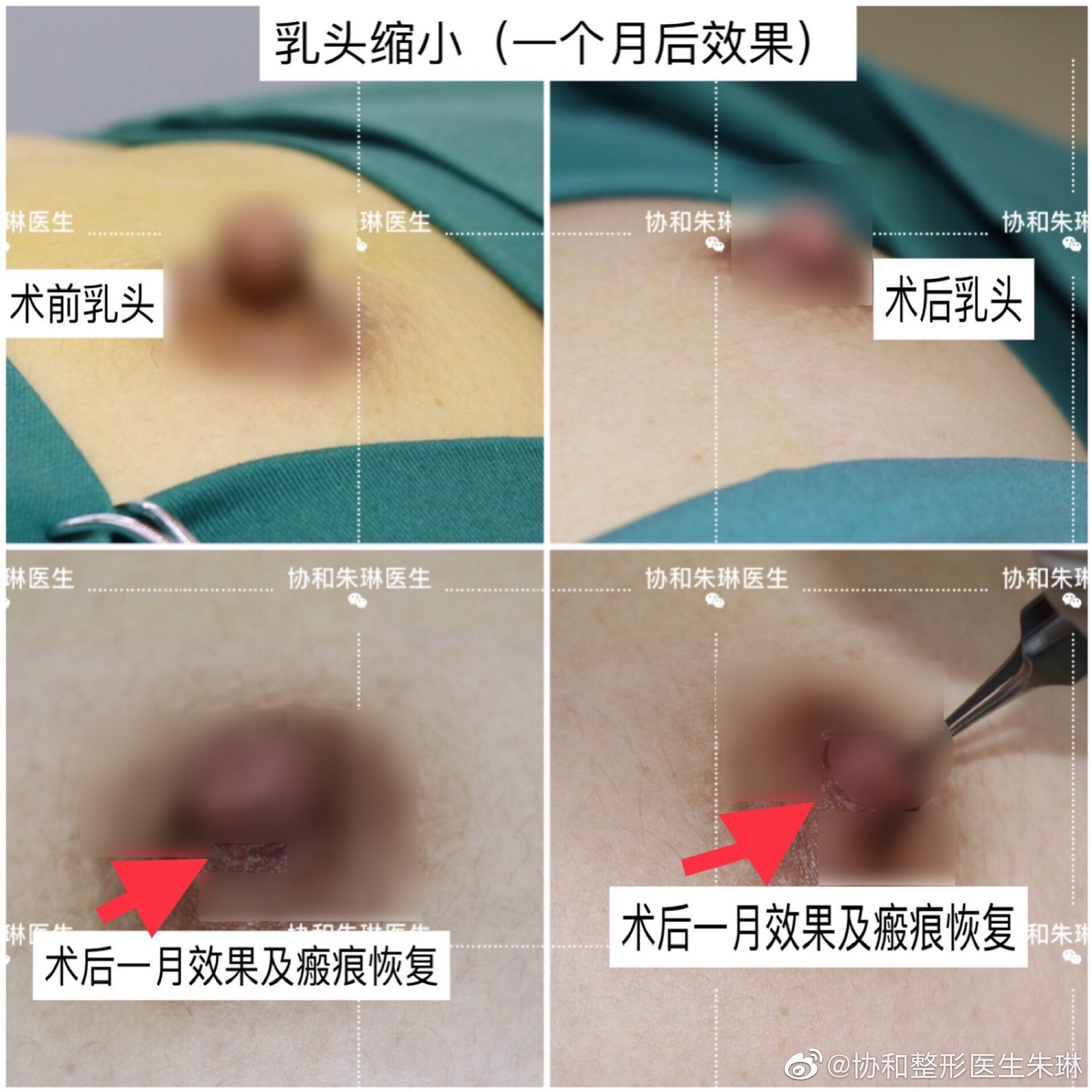 乳頭 縮小 縮小 乳頭