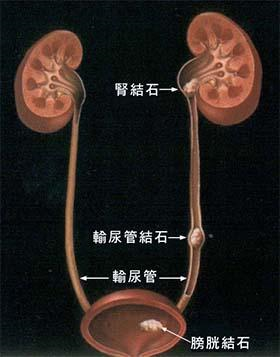 输尿管结石的治疗及预防