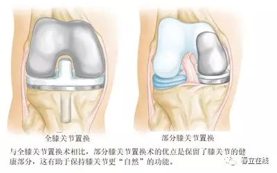 膝关节置换示意图图片