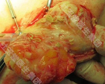 肉芽肿glm的术中所见与临床意义 - 好大夫在线