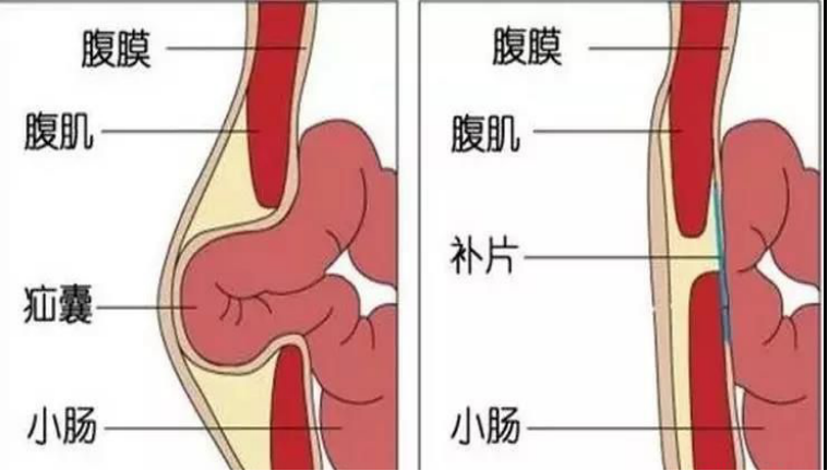 腹股沟位置图图片