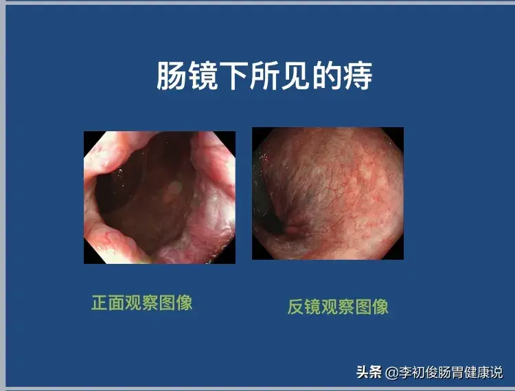 痔 直肠癌 便血 纠结的三角关系 引致多少混淆无奈事 直肠癌 好大夫在线