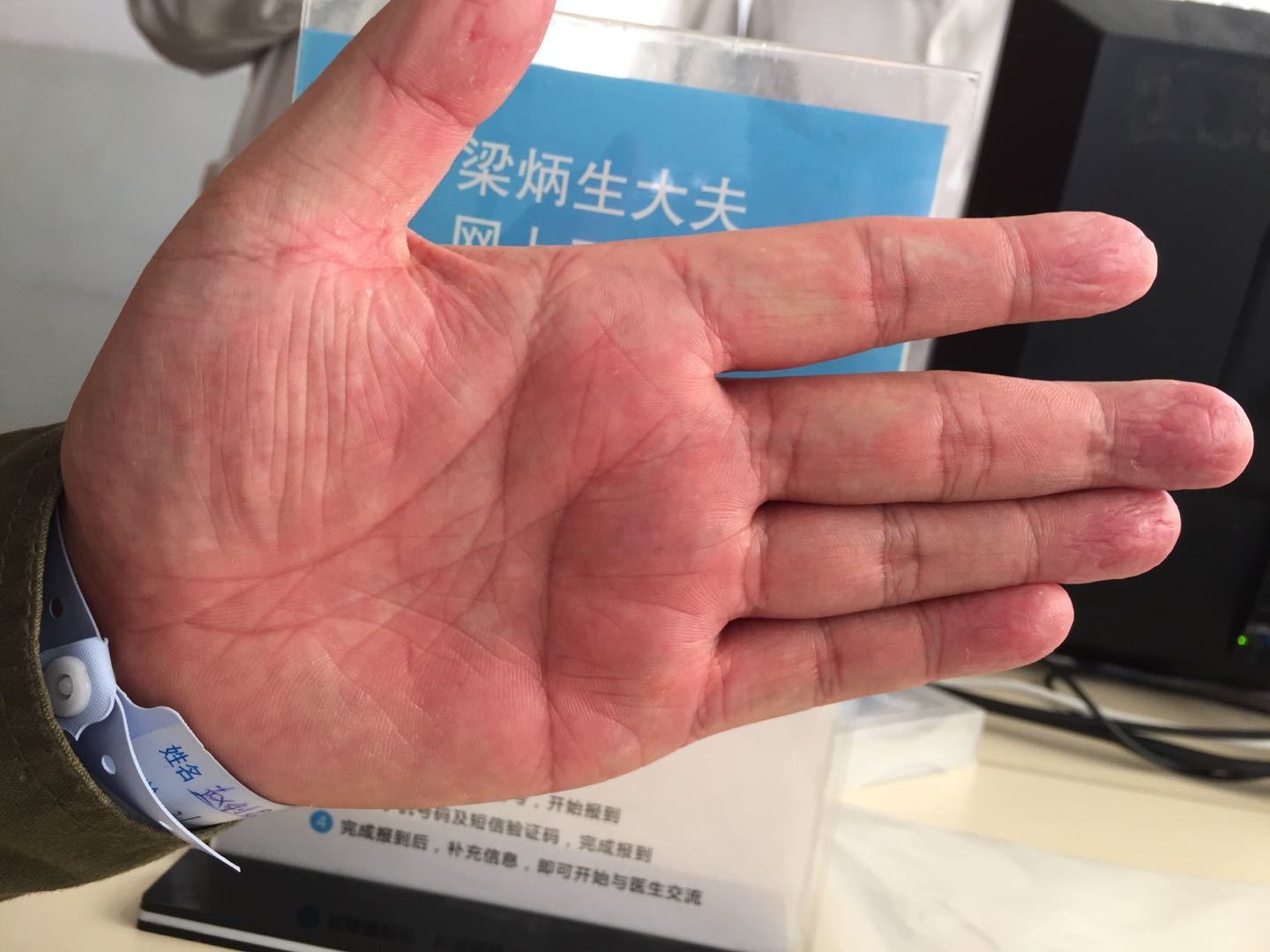 手指骨折微创手术 骨折 好大夫在线 手指骨折微创手术 骨折 好大夫在线