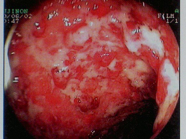 肠癌拉血图片图片
