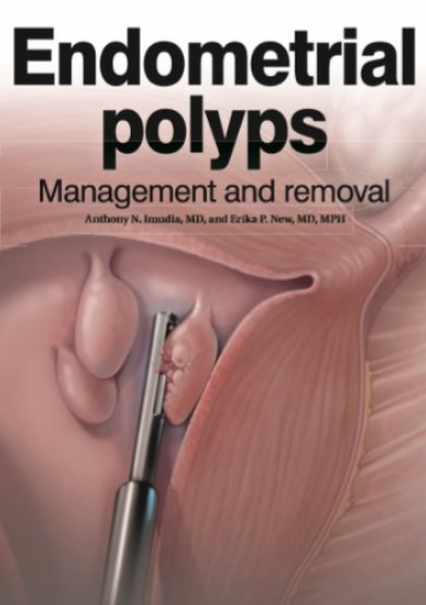 更安全更快的宫腔镜技术宫腔镜下组织旋切技术