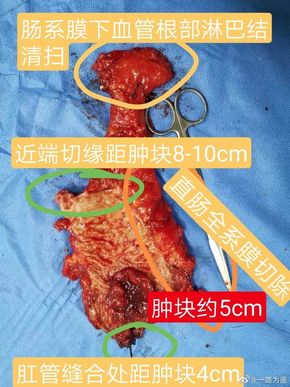 腹腔鏡直腸癌根治術一例及要點分析分享