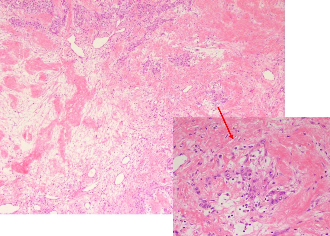 肝细胞癌切片图图片