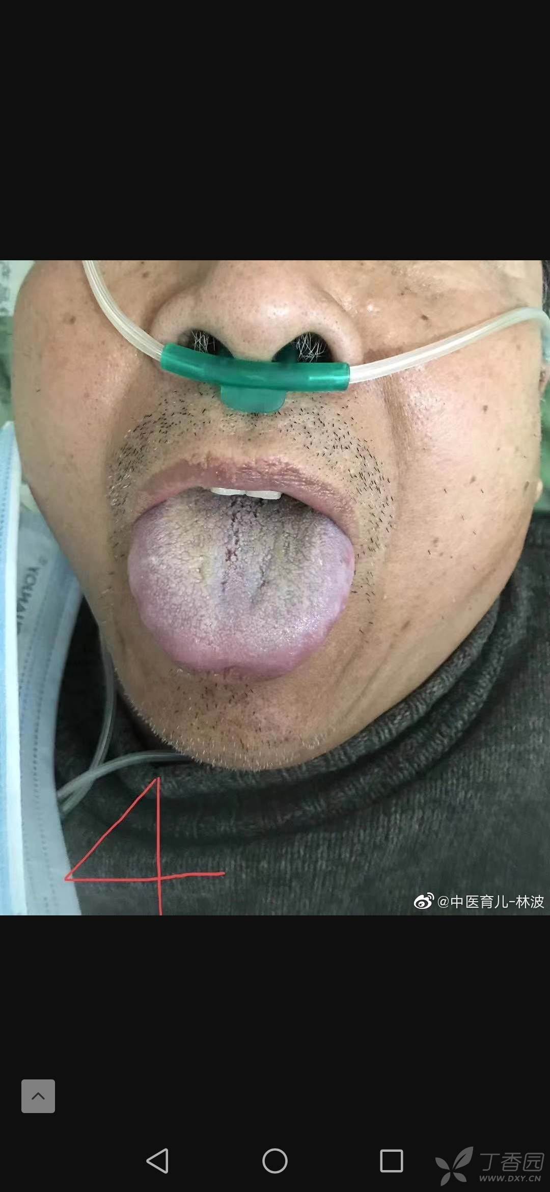 新冠肺炎舌苔颜色图片
