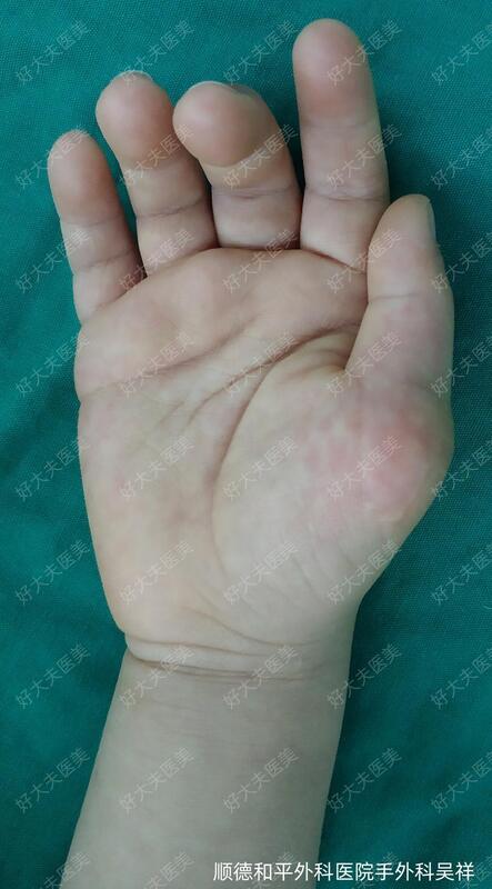 诊断: 右拇指多指切除术后:尺偏畸形,功能障碍,虎口挛缩术式:右拇指