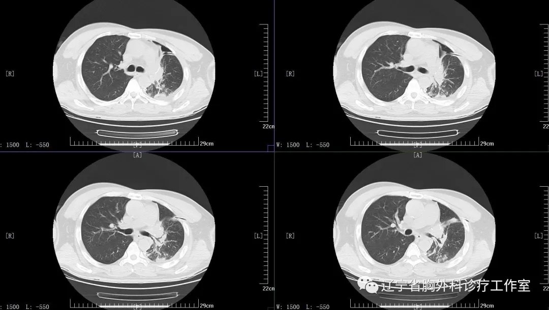 三天五例袖狀成型中央型肺癌的手術只是常規操作